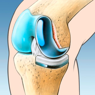 orthopaedie-zentrum-zuerich-knieteilprothese
