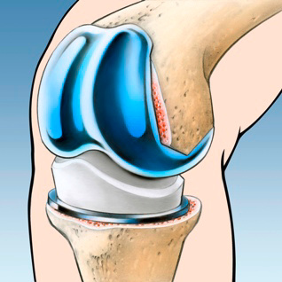 orthopaedie-zentrum-zuerich-knietotalprothese