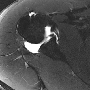 orthopaedie-zentrum-zuerich-mri-einriss-gelenkpfannenrand