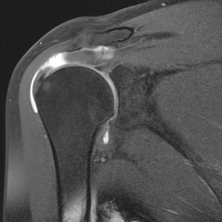 orthopaedie-zentrum-zuerich-mri-sehnenabriss