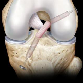 orthopaedie-zentrum-zuerich-rekonstruktion-des-kreuzbandes