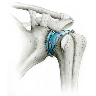 orthopaedie-zentrum-zuerich-schultergelenk-mit-arthrose