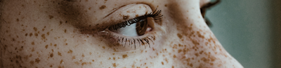 hyperpigmentation-treat