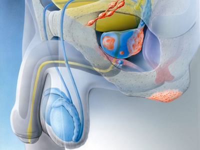 prostatakrebs-illustration