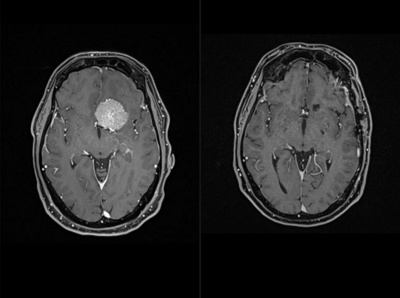 Tumeur au cerveau – diagnostic, traitement | Hirslanden