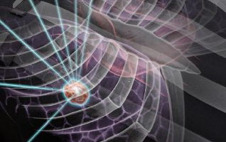 Visualisierung einer Bestrahlung