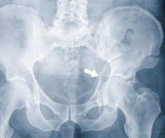 roentgenbild_acetabulumfraktur