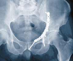 roentgenbild_acetabulumfraktur_2