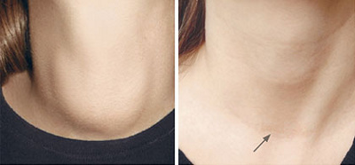 schilddruesenchirurgie_patientin_operationsnarbe