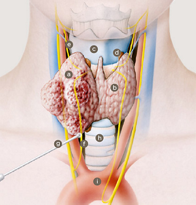 schilddruesenchirurgie_tumorbefall_schilddruesenlappen