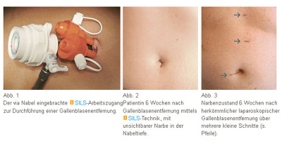 schluesselloch-operation-bauch