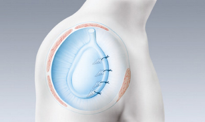 schulterstabilisierung_bandnaht