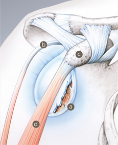 schulterstabilisierung_latarjet_1