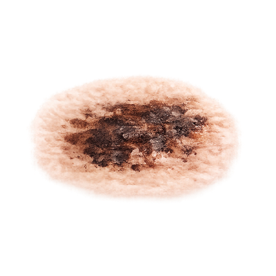 schwarzer Hautkrebs