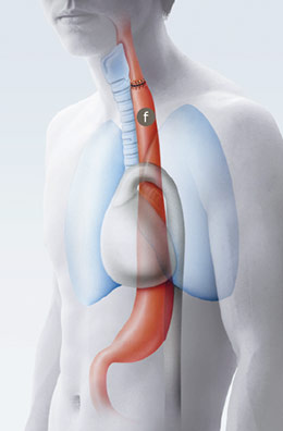 speiseroehrenkrebs_nach_operation