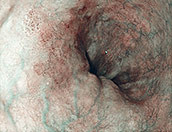 speiseroehrenkrebs_plattenepithelfruehkarzinom