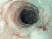 speiseroehrenkrebs_plattenepithelfruehkarzinom_abtragung