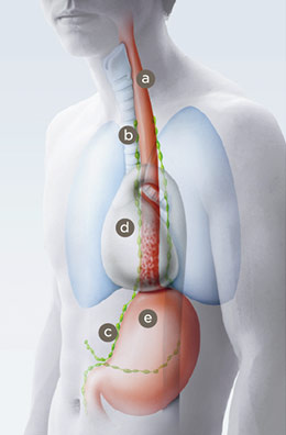 speiseroehrenkrebs_vor_operation