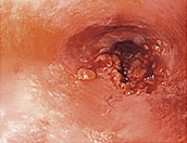 speiseroehrenkrebs_vor_operation_foto