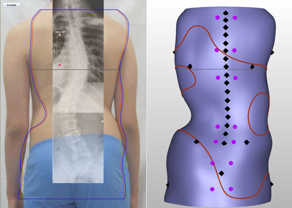 Scoliosis Bracing