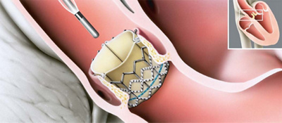 tavi_katheterbasierter_aortenklappenersatz