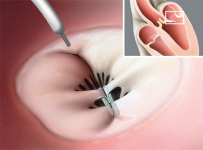 tavi_katheterbasierter_aortenklappenersatz_2