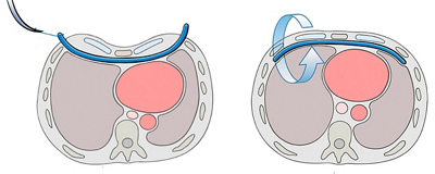 Trichterbrust – wenn die Brust ein «Loch» hat