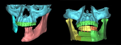 unterkieferdefekt-wiederherstellung-768x288