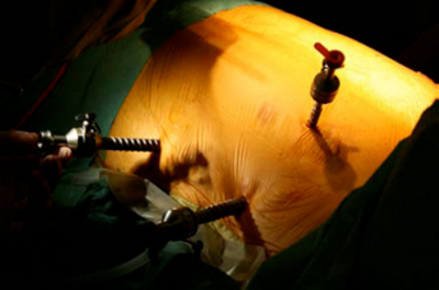 vorhofflimmern-neue-entwicklungen-und-sicht-des-herzchirurgen-1