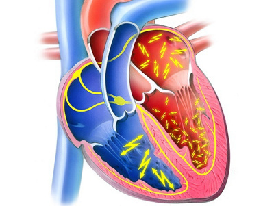 vorhofflimmern_blogbild