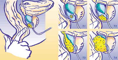 vorsorge-beim-prostatakrebs-2
