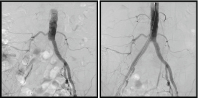 zentrum-fuer-mikrotherapie-beckenarterie