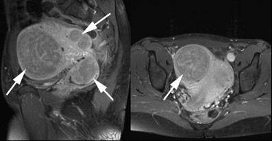 zentrum-fuer-mikrotherapie-gebaermutterknoten