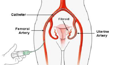 zentrum-fuer-mikrotherapie-kathetereingriff