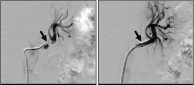 zentrum-fuer-mikrotherapie-nierenarterie