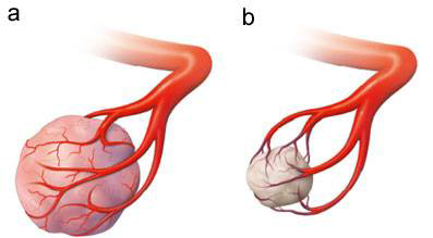 zentrum-fuer-mikrotherapie-schrumpfung