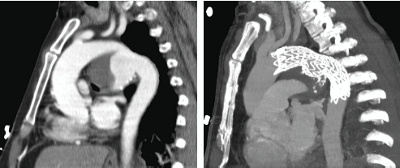 zentrum-fuer-mikrotherapie-stent-graft